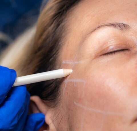 Aesthetic Mesotherapy Thread Face Lifting. Anti-aging Cosmetic Treatment